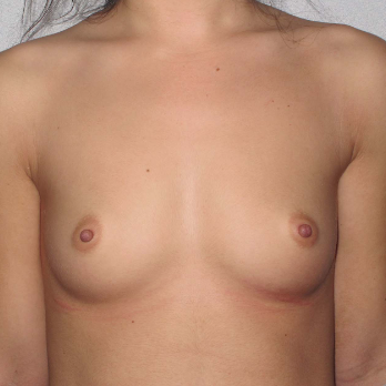 Front view of patient before Breast Augmentation Surgery