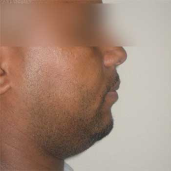 Side view of male patient prior to Facial Liposculpture surgery