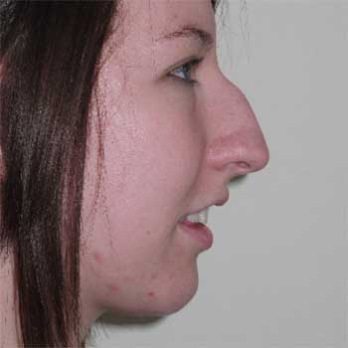 Side profile before rhinoplasty surgery