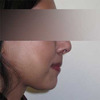 Side view of female patient after chin implant surgery
