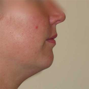 Side view of female patient prior to chin implant surgery