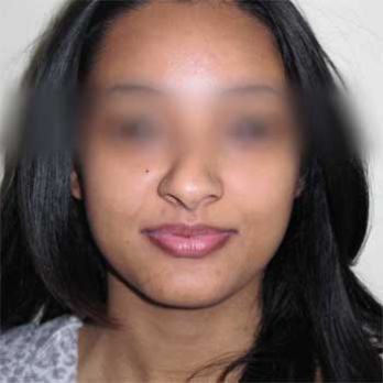 Front view before rhinoplasty surgery