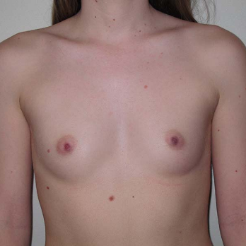 Front view of patient prior to Breast Augmentation surgery