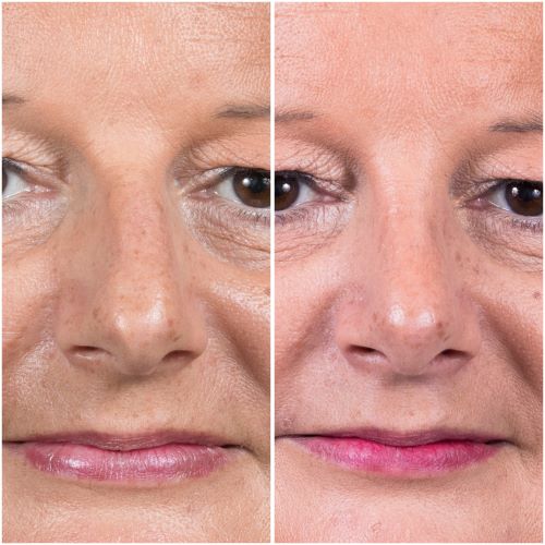 Ultrascopic rhinoplasty before and after