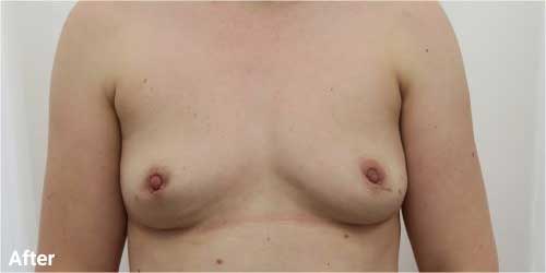 breast implant removal surgery before and after