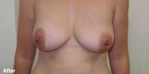 breast implant removal surgery before and after