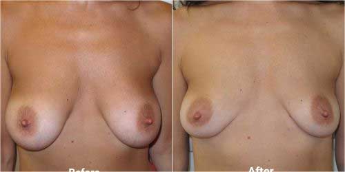 breast implant removal surgery before and after 