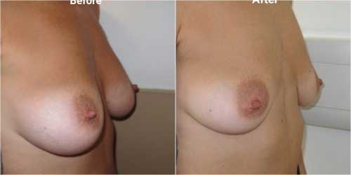 breast implant removal surgery before and after