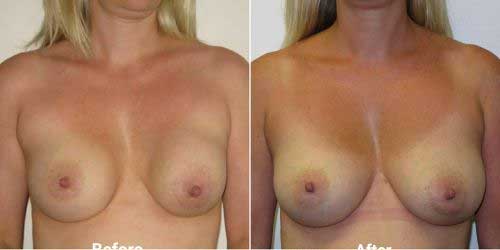 Breast implant replacement surgery before and after 