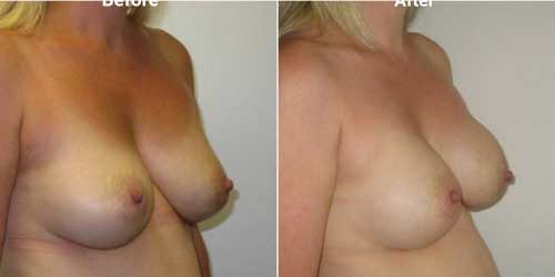 Breast implant replacement surgery before and after