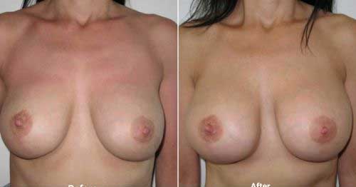 Breast implant replacement surgery before and after 