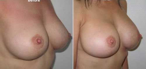 Breast implant replacement surgery before and after