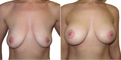 breast-uplift-surgery-wth-implants 