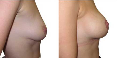 breast-uplift-surgery-wth-implants