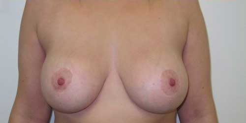 breast-uplift-surgery-wth-implants