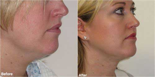 Chin liposuction surgery before and after 