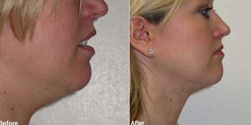 Chin liposuction surgery before and after