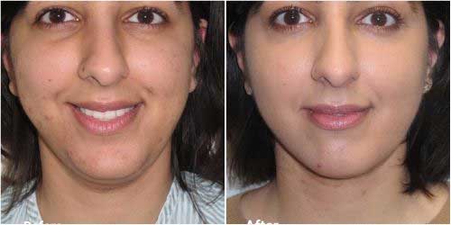 Vaser Chin Liposuction surgery before and after  