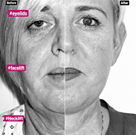 Facelift with necklift and blepharoplasty