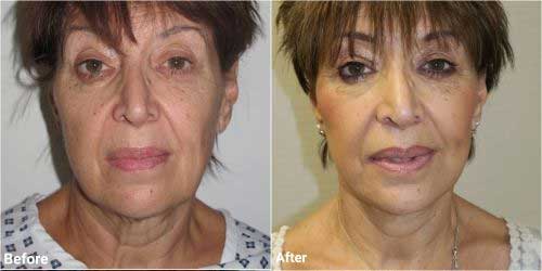 Facelift before and after in 60 year old patient 