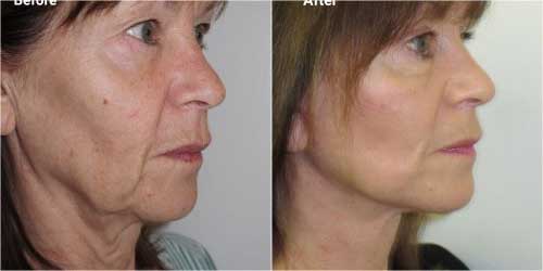 Facelift surgery before and after in 65 year old