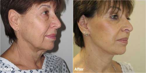 Facelift before and after in 60 year old patient