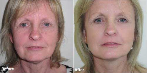 Facelift before and after in 56 year old patient 
