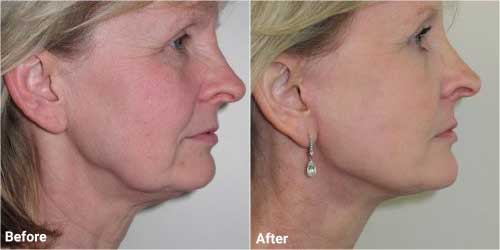Facelift before and after in 56 year old patient