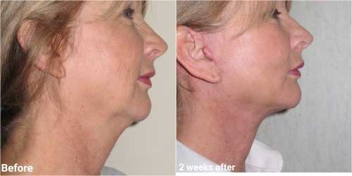 Faclelift surgery before and after 2 week recovery