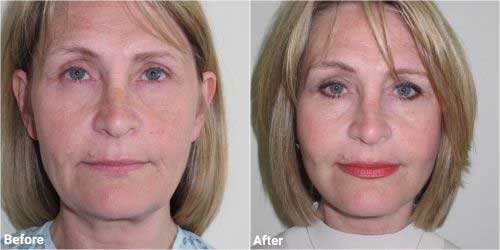 Facelift surgery before and after in 50 year old 