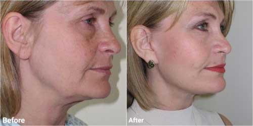 Facelift surgery before and after in 50 year old