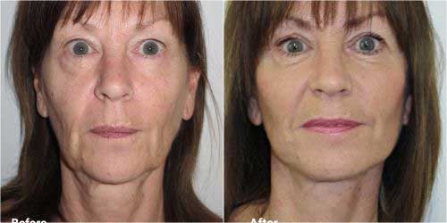 Facelift surgery before and after in 65 year old 