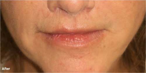 Lip lift surgery before and after