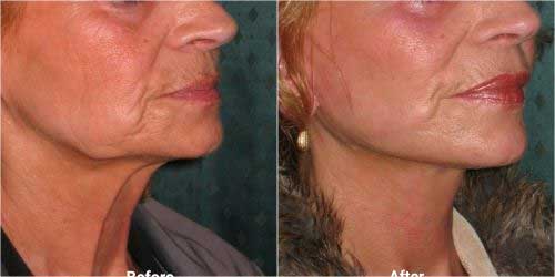 necklift surgery with plastysmaplasty before and after 