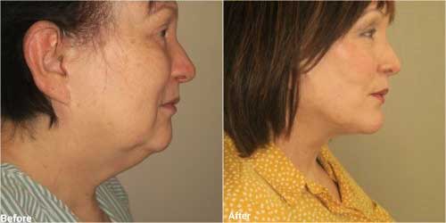 Necklift surgury with chin implant before and after