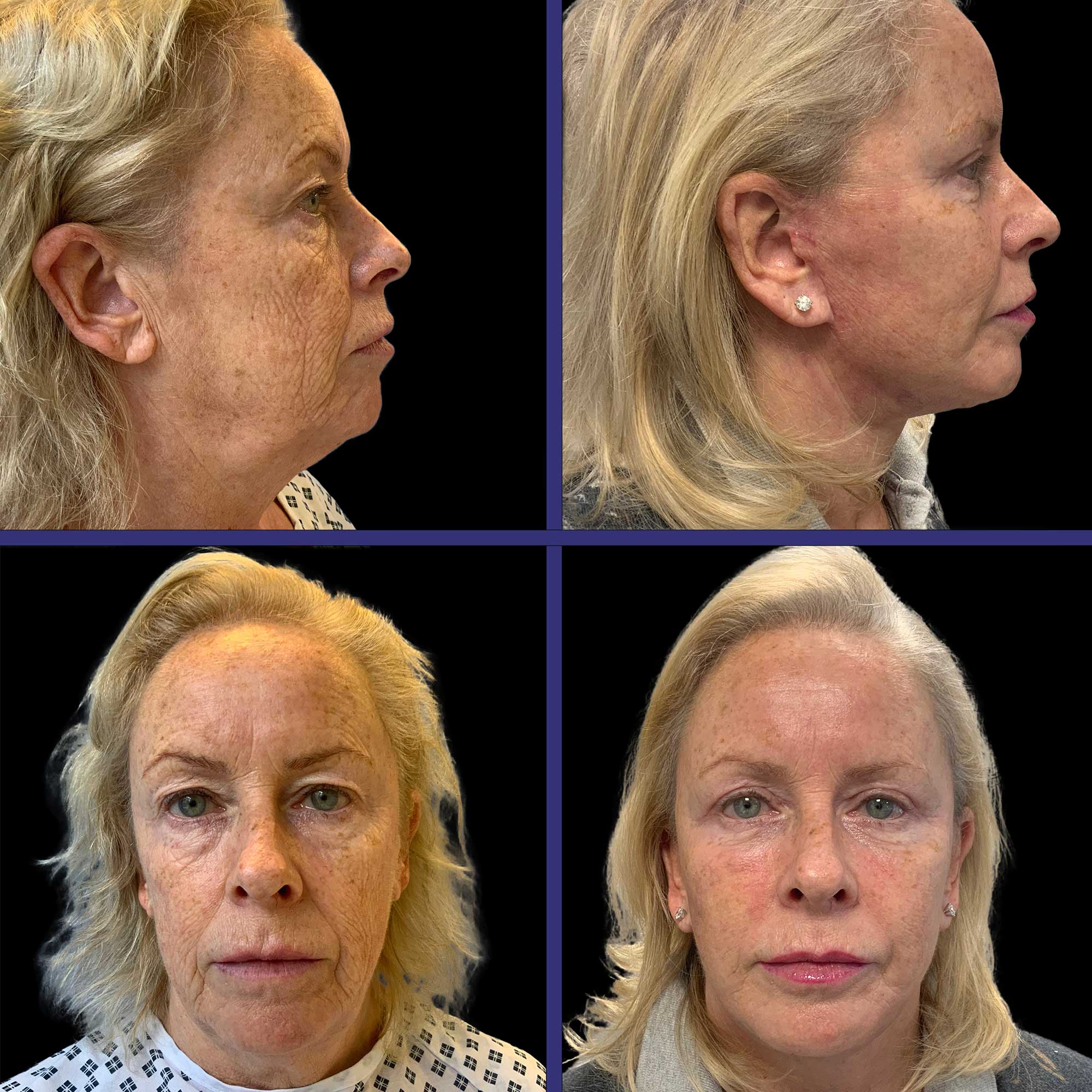 stem cell facelift patient case study before and after