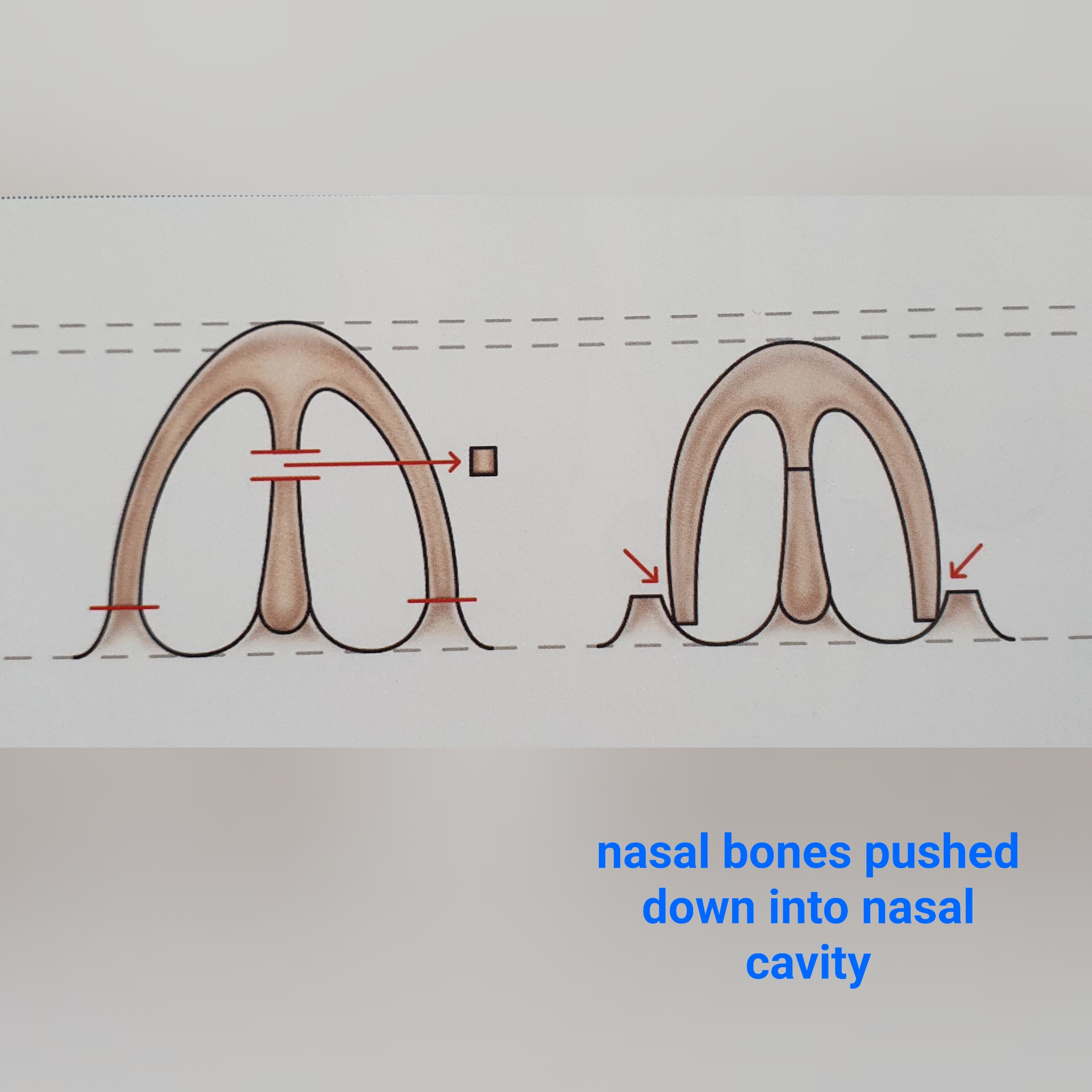 push-down-rhinoplasty-technique