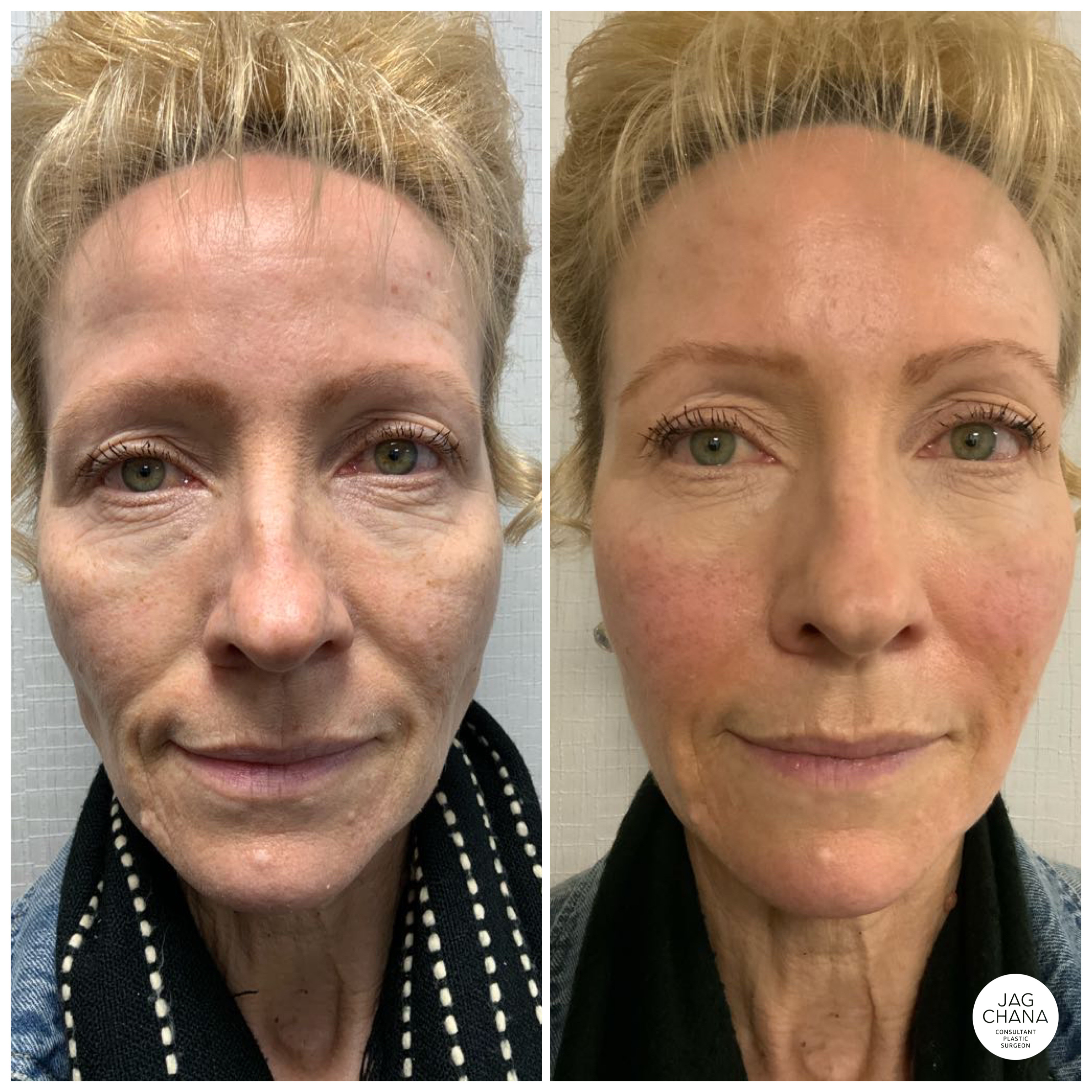 non-surgical facelift procedure