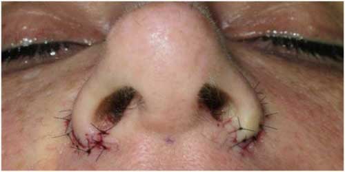 nostril reduction surgery after image