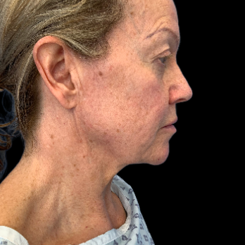 Deep plane Facelift and Necklift surgery before and after photos