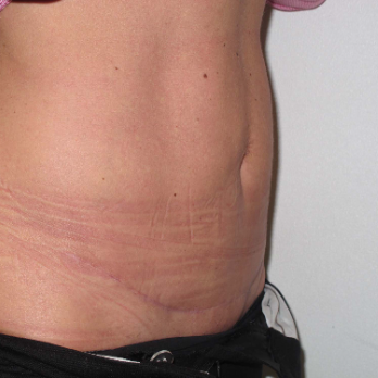 Side view of patient after Abdominoplasty surgery