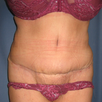 Front view of patient after Abdominoplasty surgery