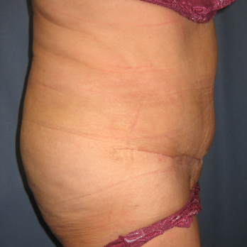 Side view of patient after Abdominoplasty surgery