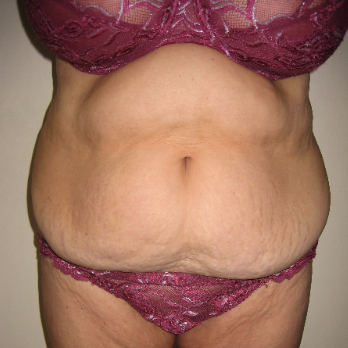 Front view of patient prior to Abdominoplasty surgery