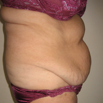 Side view of patient prior to Abdominoplasty surgery