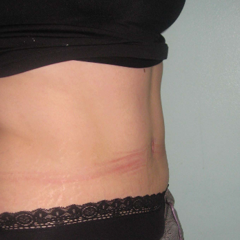 Side view of female patient after Abdominoplasty surgery