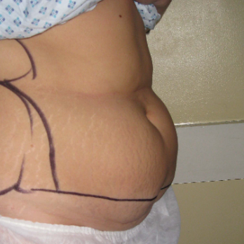 Side view of female patient before Abdominoplasty Surgery