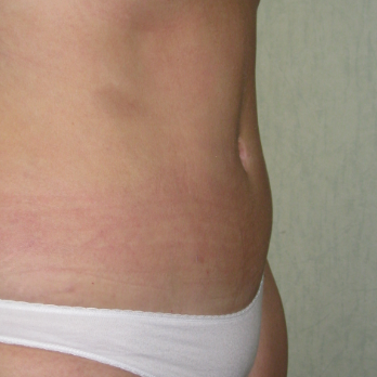 Side view of patient after Abdominoplasty surgery