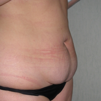 Side view of patient prior to Abdominoplasty surgery