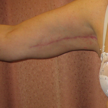 Front view of female patient after Brachioplasty Arm Lift surgery